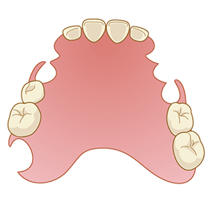 ノンスクプデンチャーのイラスト