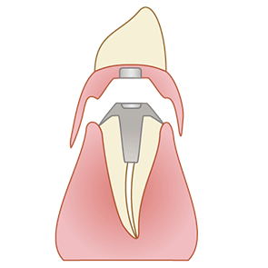 磁性アタッチメントのイラスト